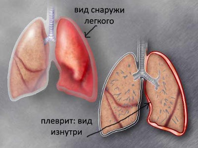 Очень сильно болит правый бок и отдает в спину что это может быть