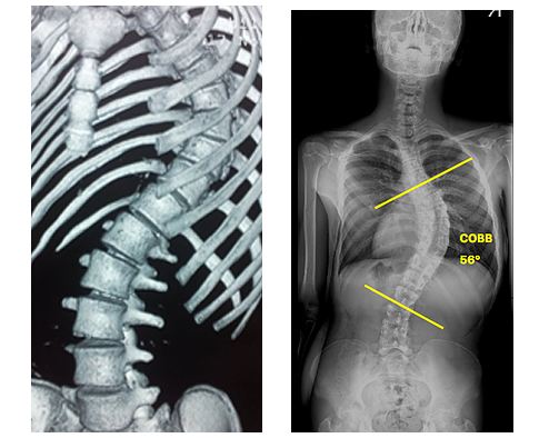 Из за чего болит левая лопатка спины и левое плечо руки