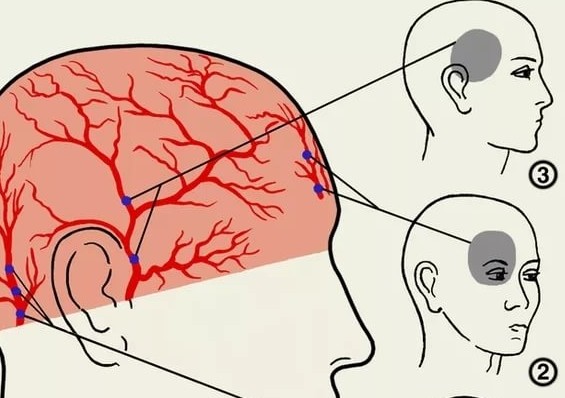 Зажимаю глаза болит голова