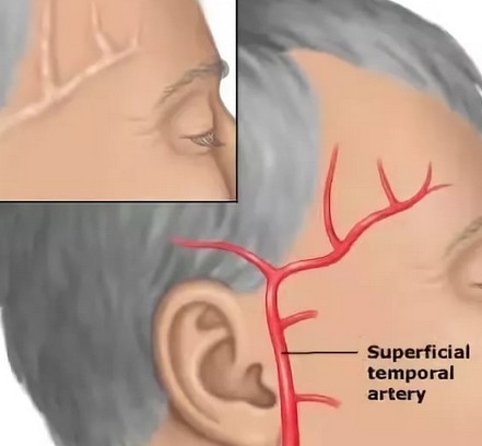 Голова болит в правой височной части головы