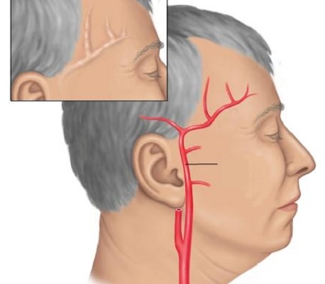 Болит левая часть головы отдает в висок и в глаз