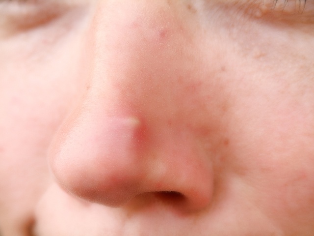 почему по утрам заложен нос и болит голова