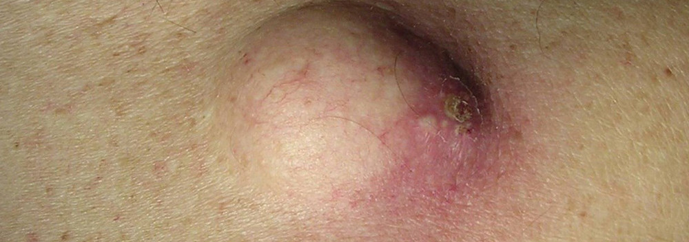 На спине шишка которая болит