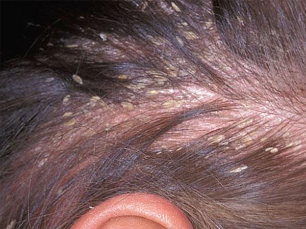 Коросты на голове болят