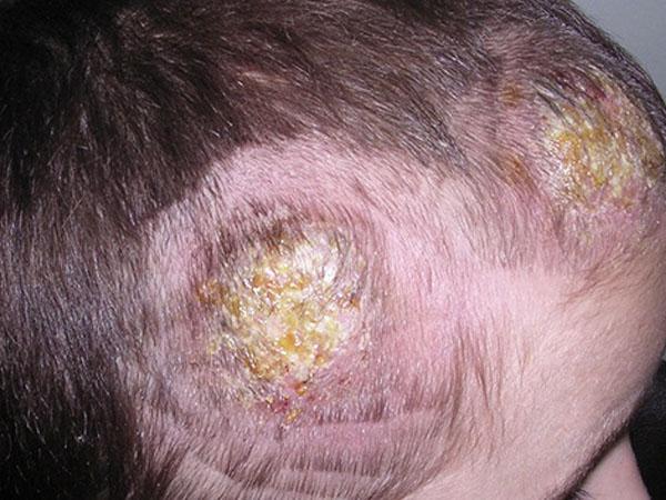 Коросты на голове болят