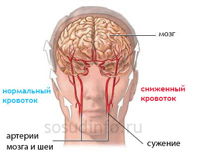 Как болит голова при сужении сосудов головного мозга