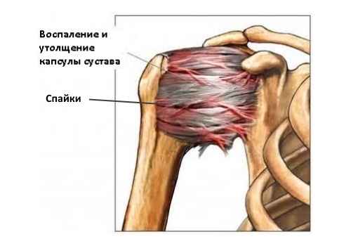 Адгезивный капсулит плеча Адгезивный капсулит плеча