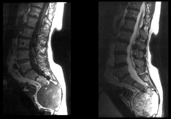 На спине шишка которая болит