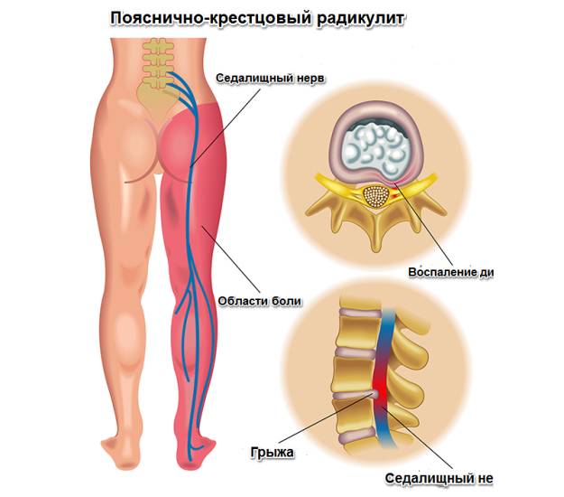 Все названия болезней когда болит спина