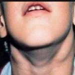 вирусна инфекция горла