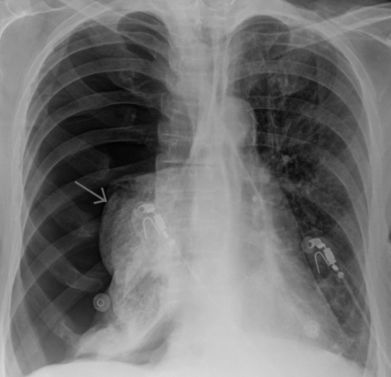 Очень сильно болит правый бок и отдает в спину что это может быть