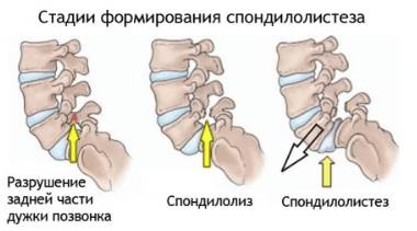 от чего болит спина по ночам в пояснице