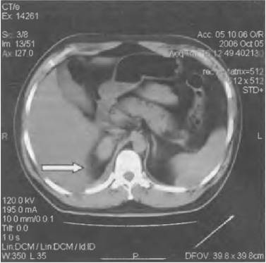 Очень сильно болит правый бок и отдает в спину что это может быть