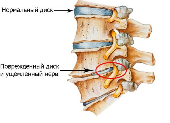 Ущемленный нерв между позвонками