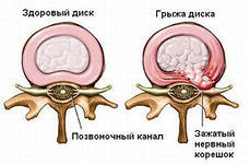 что делать если болит спина у спортсмена