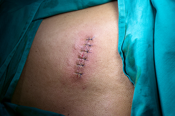 На спине шишка которая болит