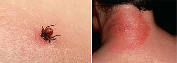 Укус клеща и болезнь Лайма