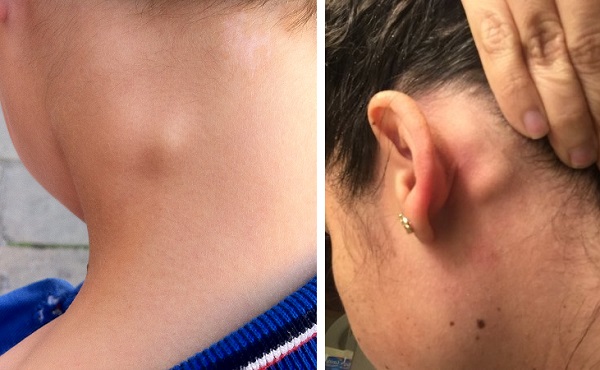 Увеличенный лимфатический узел сзади на шее и за ухом