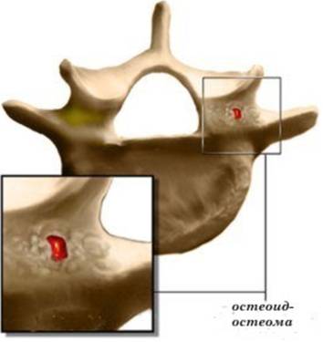 На спине шишка которая болит